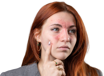 Лікування <br>розацеа